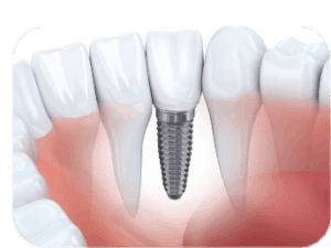Dental Implants