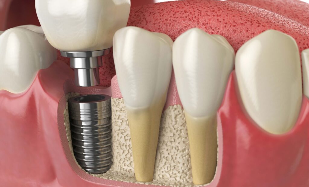 Put 2 Teeth on 1 Implant