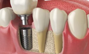 Put 2 Teeth on 1 Implant