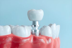 Dental Implants UK