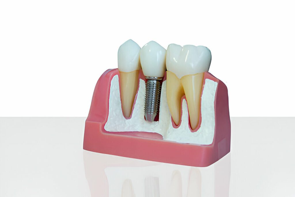 Dental Implants?