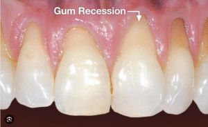 Implants with Receding Gums