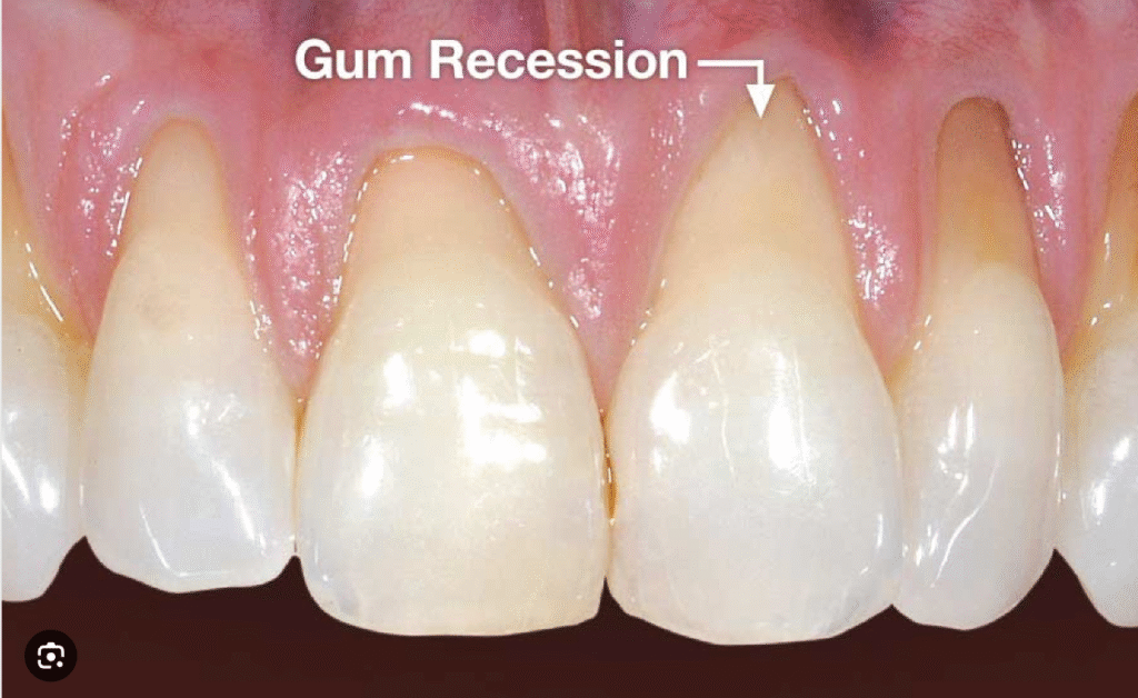 Implants with Receding Gums
