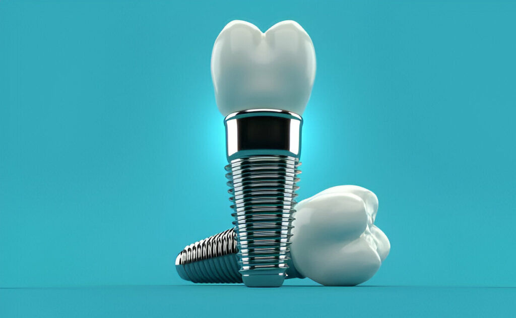 Dental Implant